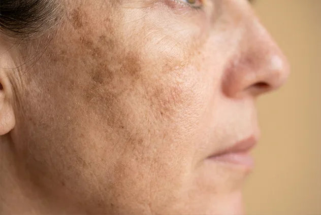 Nekrimpels en verslapping